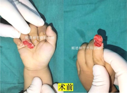 和平醫(yī)院成功為2歲男童實(shí)現(xiàn)“手指再生”