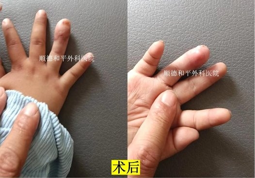 和平醫院成功為2歲男童實現“手指再生”_手外科醫院咨詢(圖2)