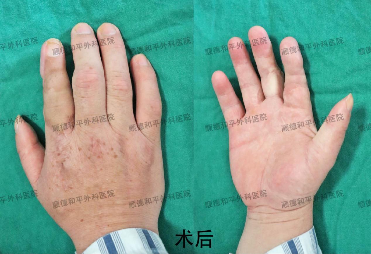 新疆患者失去手指心生自卑，遠赴廣東手指再造＿手外科醫院咨詢(圖2)
