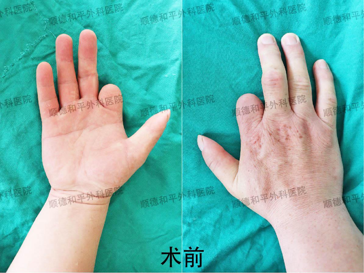 新疆患者失去手指心生自卑，遠赴廣東手指再造＿手外科醫院咨詢(圖1)