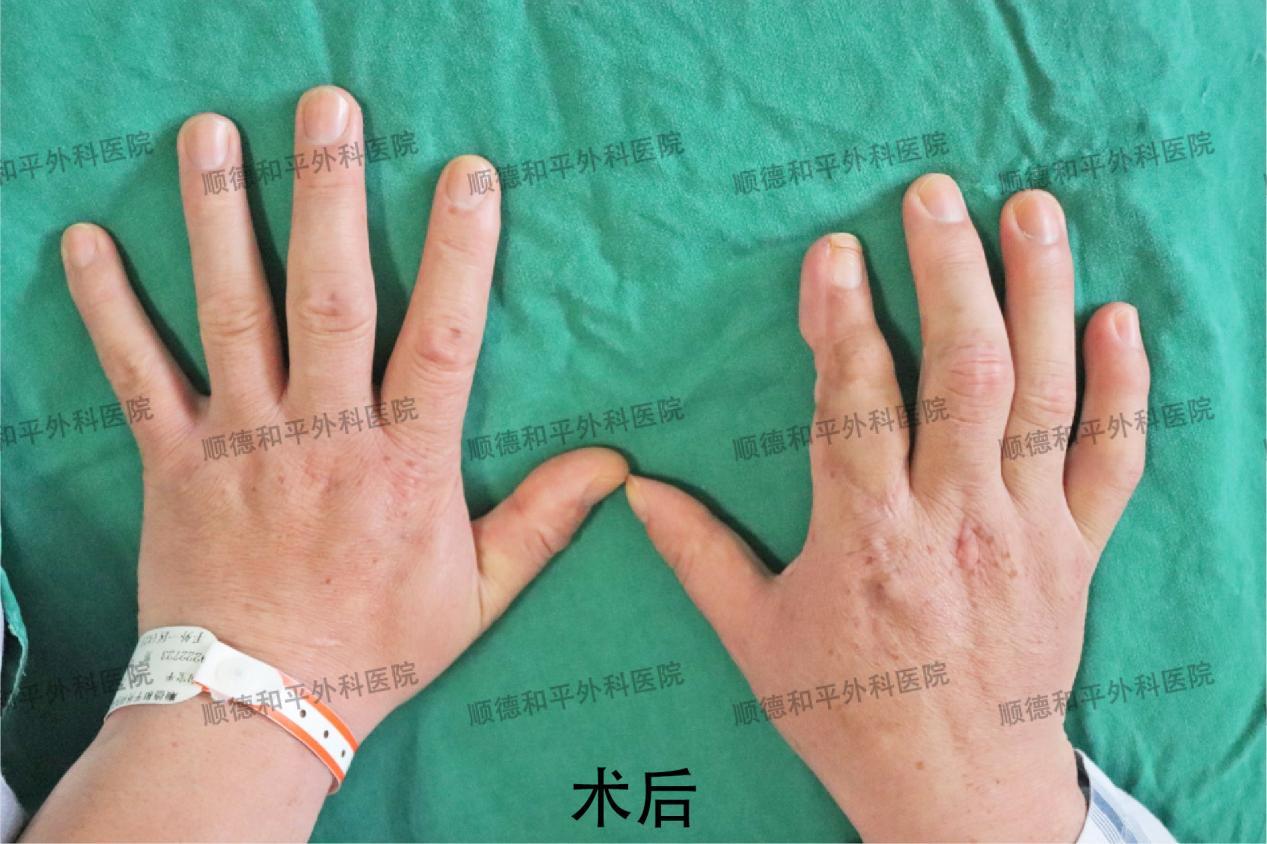 新疆患者失去手指心生自卑，遠赴廣東手指再造＿手外科醫院咨詢(圖3)