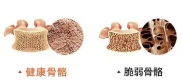 科普氨糖軟骨素鈣片養(yǎng)護原理及氨糖軟骨素鈣片正確吃法(圖4)
