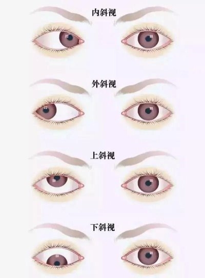 愛爾眼科：總愛偏頭看，視力“一好一壞”？警惕斜視！(圖1)