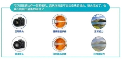 愛爾眼科：白內障不會“缺席”只會“遲到”？(圖1)