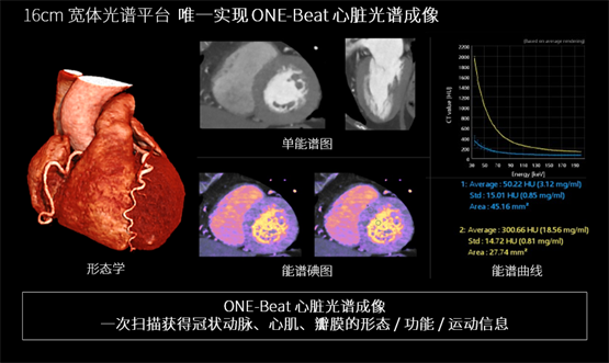 登陸中國(guó),首款16cm光譜成像、超高清寬體CT國(guó)產(chǎn)上市(圖3) 登陸中國(guó),首款16cm光譜成像、超高清寬體CT國(guó)產(chǎn)上市(圖3)