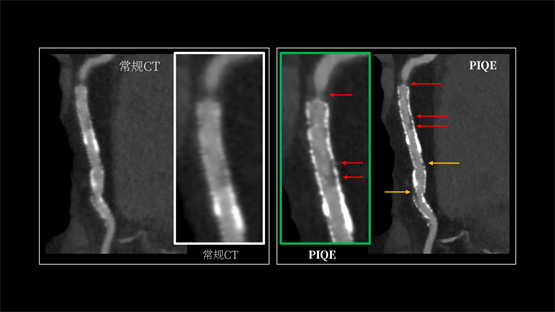 登陸中國(guó),首款16cm光譜成像、超高清寬體CT國(guó)產(chǎn)上市(圖4) 登陸中國(guó),首款16cm光譜成像、超高清寬體CT國(guó)產(chǎn)上市(圖4)