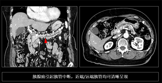 登陸中國(guó),首款16cm光譜成像、超高清寬體CT國(guó)產(chǎn)上市(圖5) 登陸中國(guó),首款16cm光譜成像、超高清寬體CT國(guó)產(chǎn)上市(圖5)